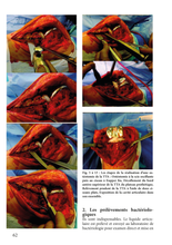 Charger l'image dans la galerie, L'infection ostéo-articulaire T1 : 2009-2017