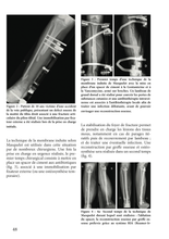 Charger l'image dans la galerie, L'infection ostéo-articulaire T2 : 2018-2022