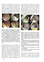 Charger l'image dans la galerie, Le ligament croisé antérieur T2