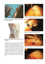 Charger l'image dans la galerie, Le ligament croisé antérieur T2