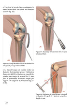 Charger l'image dans la galerie, Le ligament croisé postérieur