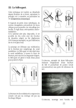 Charger l'image dans la galerie, Ostéosynthèses de la main