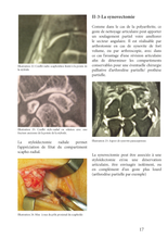 Charger l'image dans la galerie, Arthrose du poignet