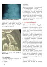 Charger l'image dans la galerie, Fracture et pseudarthrose du scaphoïde