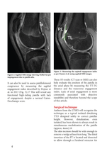 Charger l&#39;image dans la galerie, Anterior tibial tuberosity distalization osteotomy for painful patella alta
