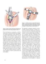 Charger l&#39;image dans la galerie, A subscapularis-sparingapproach for reverse total shoulder arthroplasty
