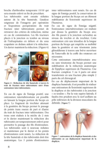 Charger l&#39;image dans la galerie, Point technique sur les ostéosutures des fractures de l’extrémité supérieure de l’humérus et clou
