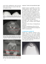 Charger l&#39;image dans la galerie, Is there a place for MPFL reconstruction in a total knee arthroplasty
