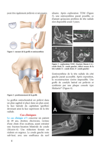Charger l&#39;image dans la galerie, Reconstruction de la tête radiale par une greffe du condyle latéral
