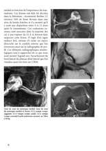 Charger l&#39;image dans la galerie, Le ligament croisé antérieur T3
