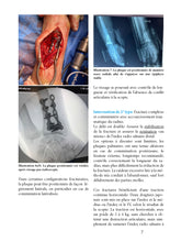 Charger l&#39;image dans la galerie, Fracture complexe à déplacement dorsal du radius : changement de paradigme
