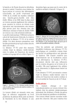 Charger l&#39;image dans la galerie, Ostéotomie de correction d’une déformation tibiale supra-tubérositaire
