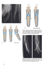 Charger l&#39;image dans la galerie, Traumatismes de l’articulation interphalangienne proximale des doigts longs en pédiatrie
