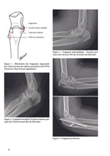 Charger l&#39;image dans la galerie, Comment je traite les fractures de l’olécrâne
