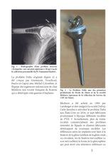 Charger l&#39;image dans la galerie, Notre expérience de l’utilisation de la prothèse inversée d’épaule et de la prise en charge de ses complications
