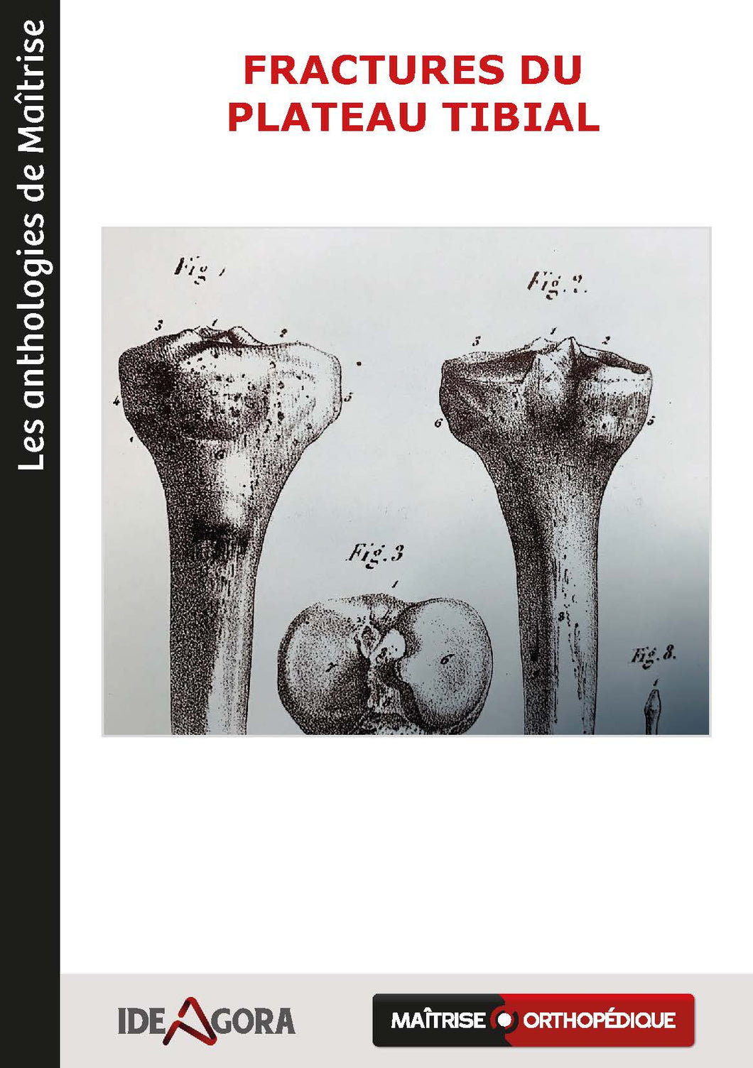 Fractures du plateau tibial