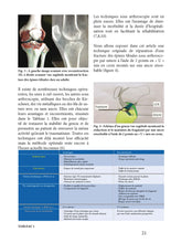 Charger l&#39;image dans la galerie, Fractures du plateau tibial
