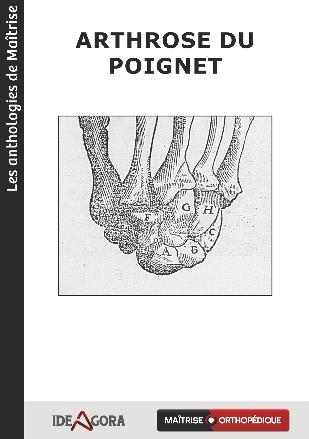 Arthrose du poignet