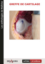 Charger l&#39;image dans la galerie, Greffe de cartilage
