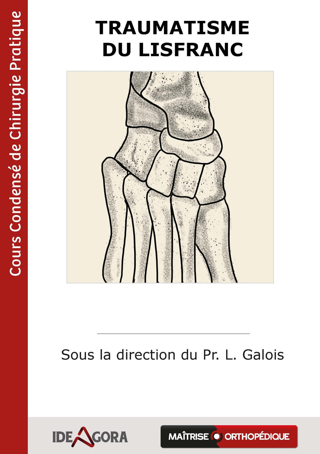 Traumatisme du Lisfranc