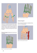 Charger l&#39;image dans la galerie, Traumatisme du Lisfranc
