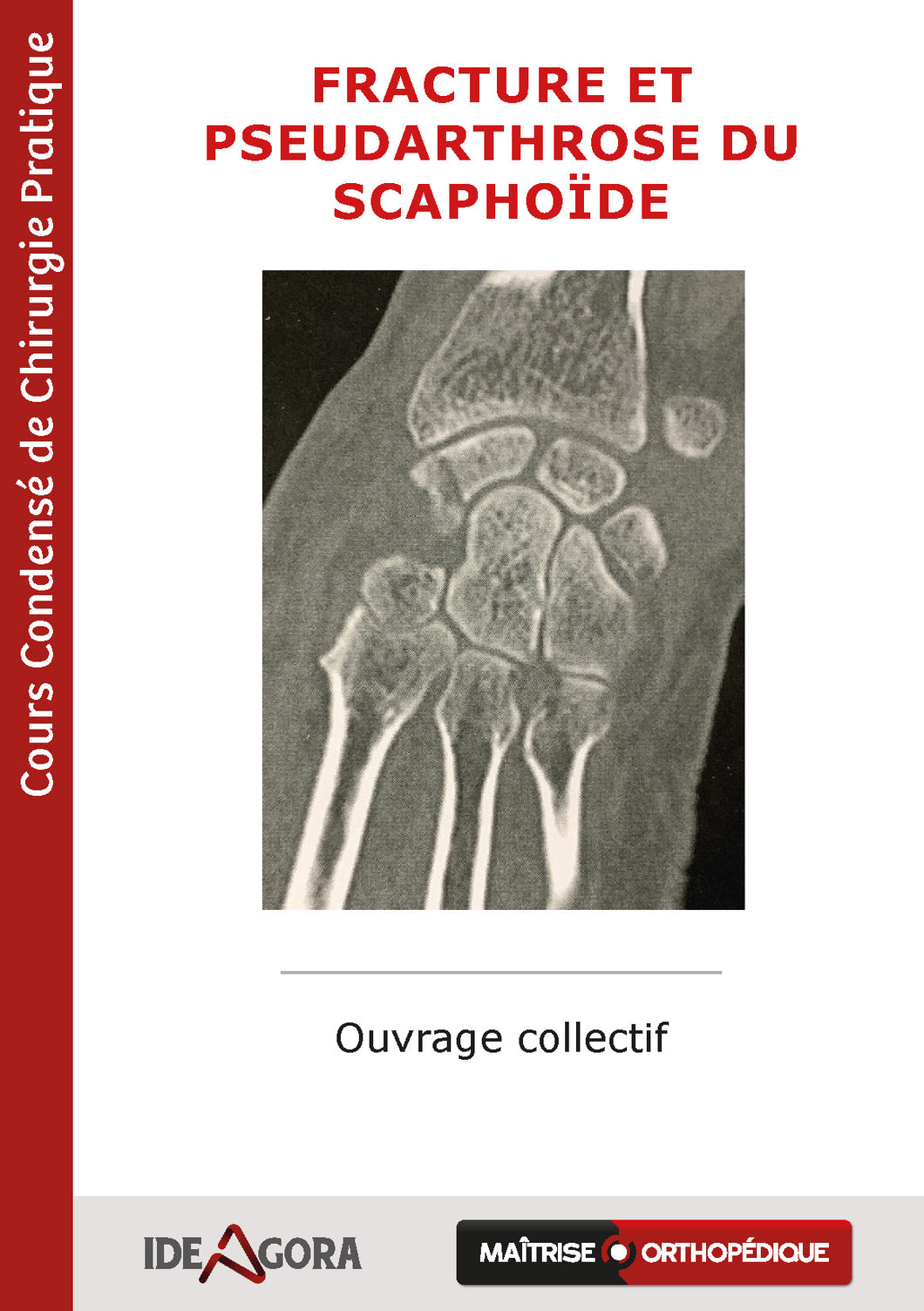 Fracture et pseudarthrose du scaphoïde